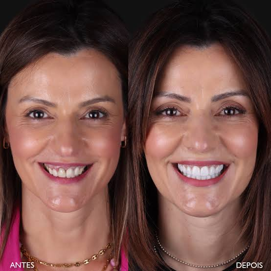 Facetas Dentárias